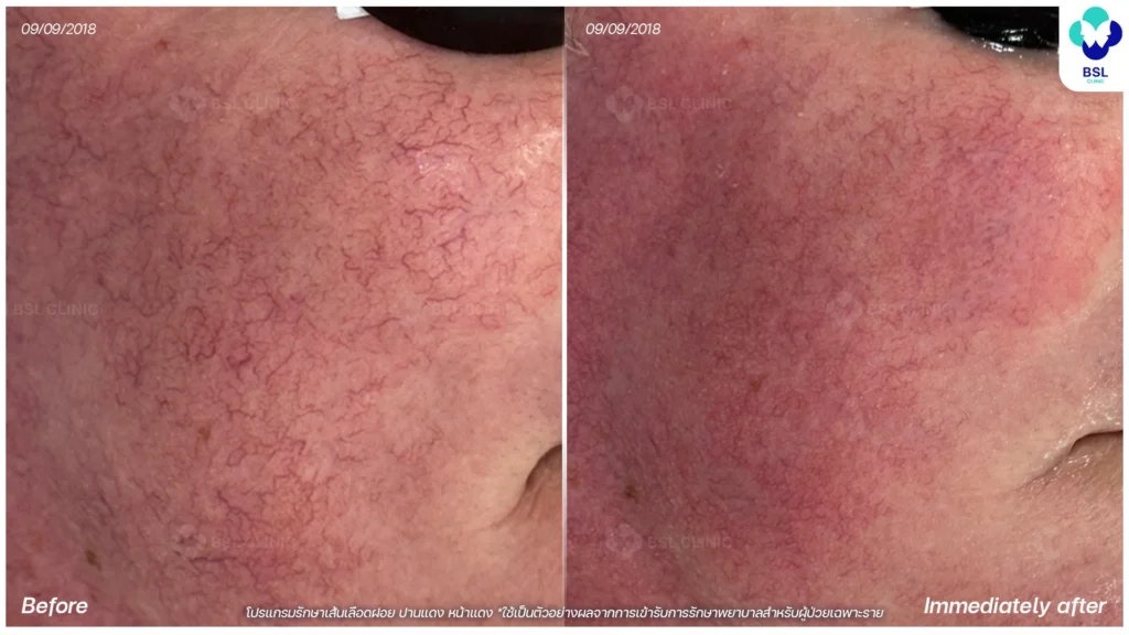 รีวิวรักษารอยแดง