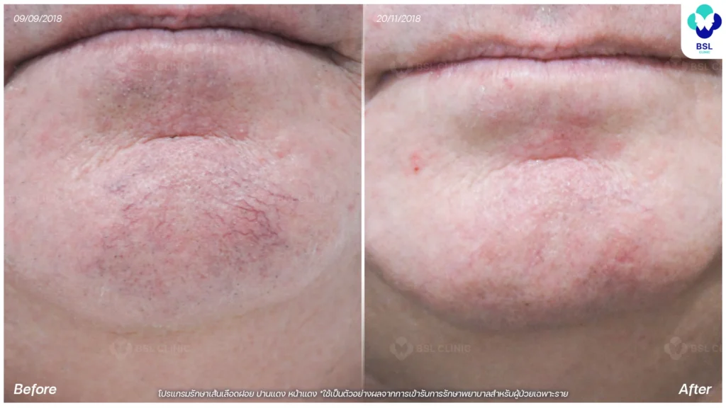 รีวิวรักษาเส้นเลือกขอด