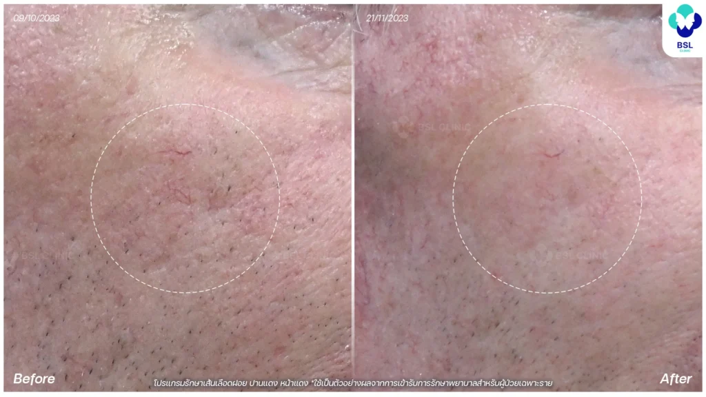 รีวิวรักษาเส้นเลือกขอด