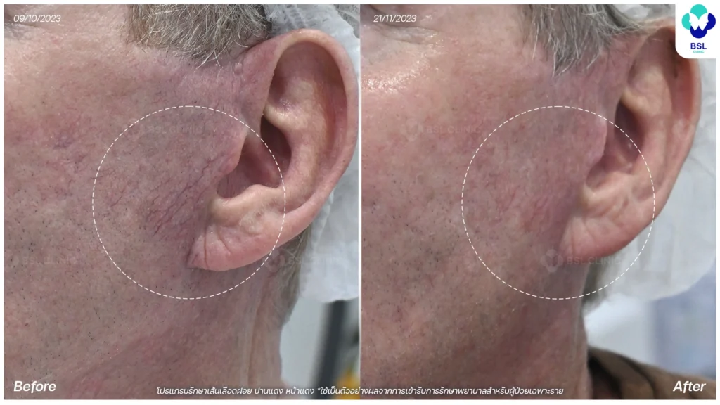 รีวิวรักษาเส้นเลือกขอด