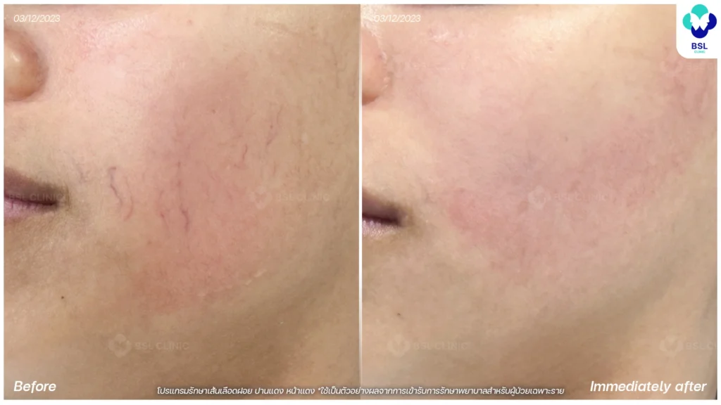 รีวิวรักษารอยแดง