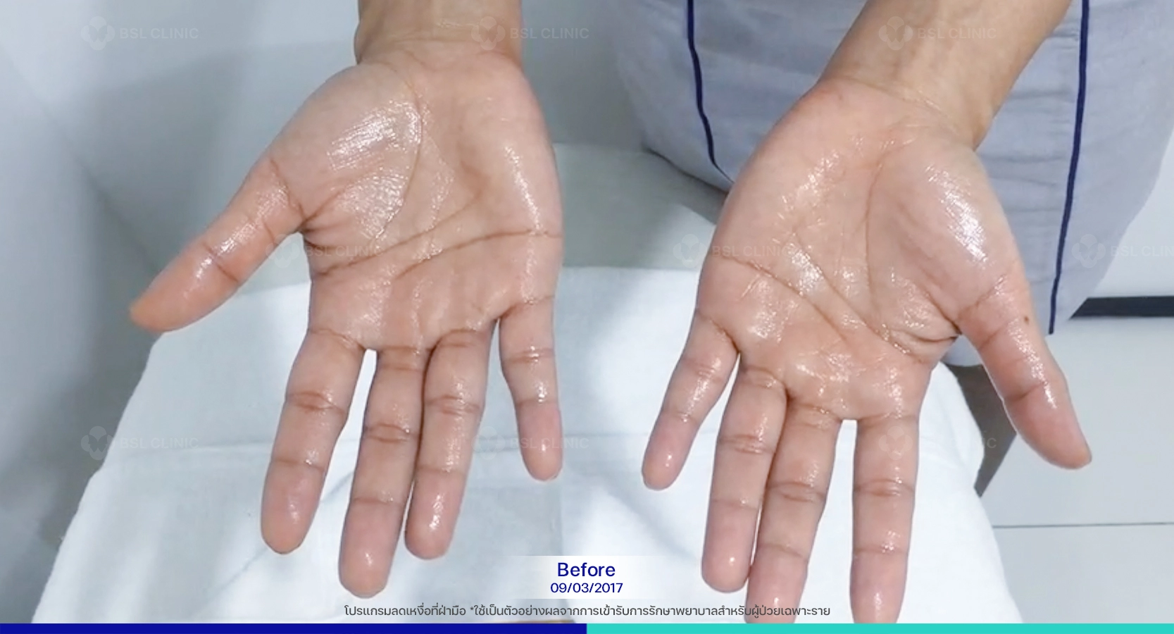 ปัญหาเหงื่อที่ออกมาก ผิดปกติที่ฝ่ามือ