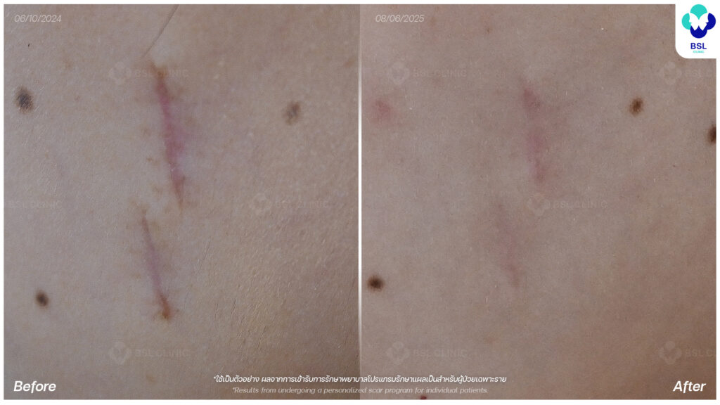 รีวิวรักษาแผลเป็น
