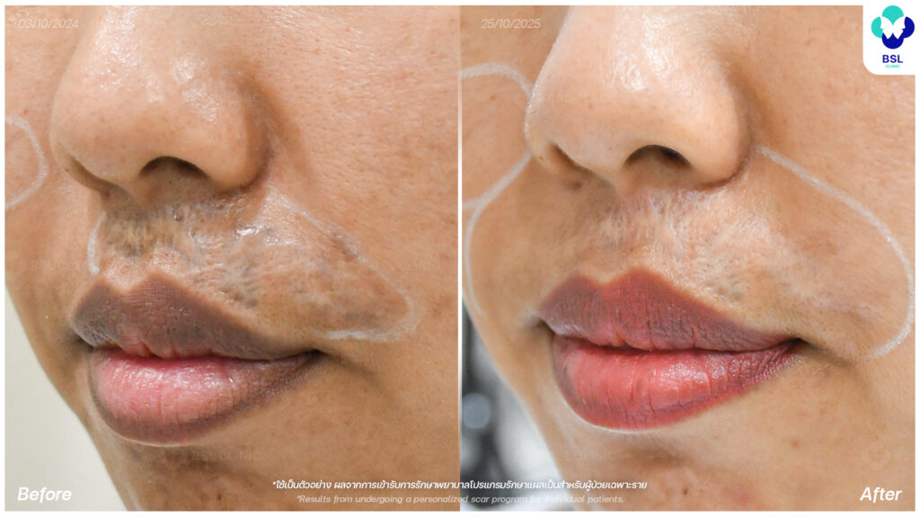 รีวิวรักษาแผลเป็น