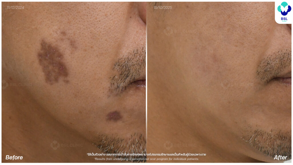 รีวิวรักษาแผลเป็น