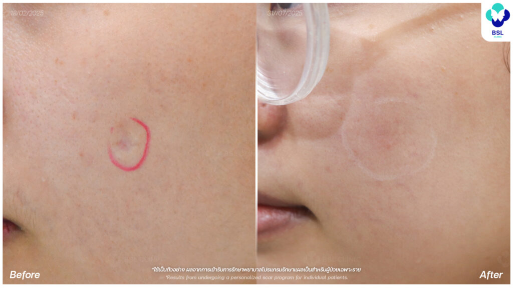 รีวิวรักษาแผลเป็น