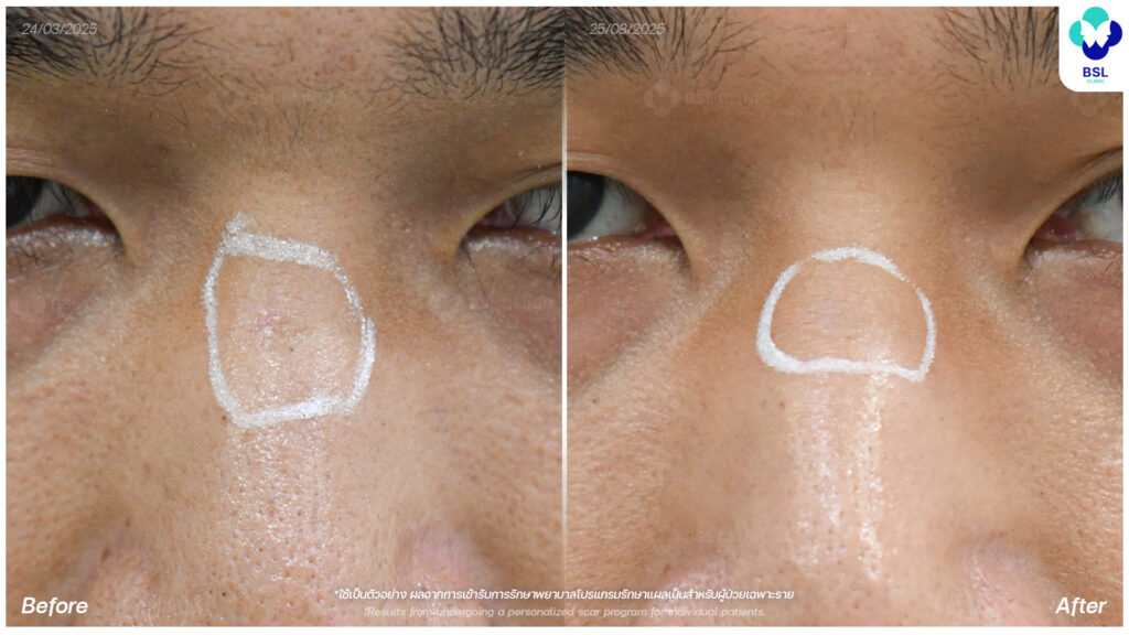 ภาพเปรียบเทียบรอยแผลเป็นก่อน–หลัง
