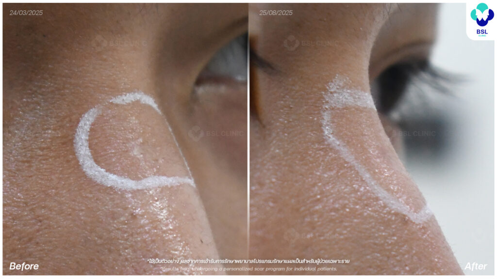 ตัวอย่างผลลัพธ์แผลเป็นเฉพาะบุคคล