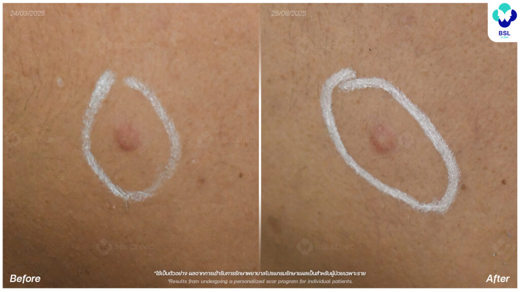 ภาพเปรียบเทียบรอยแผลเป็นก่อน–หลัง