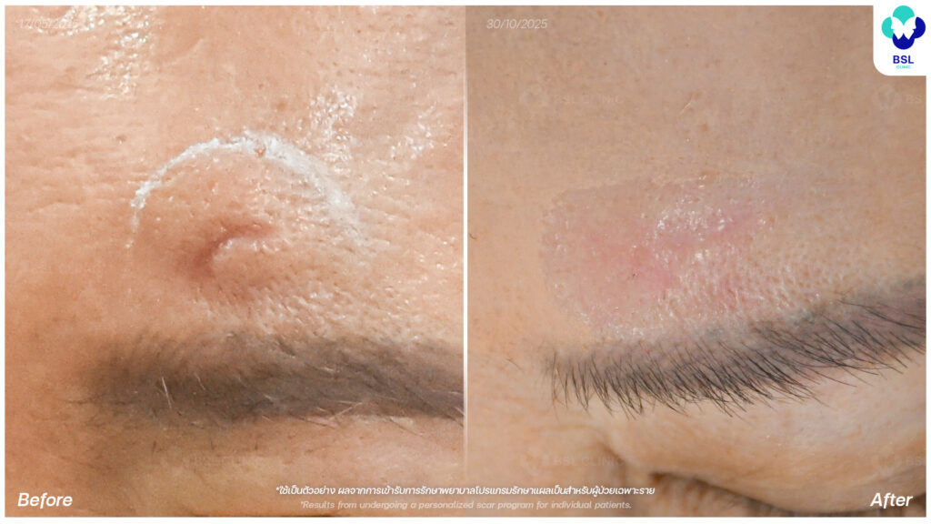 รีวิวรักษาแผลเป็น