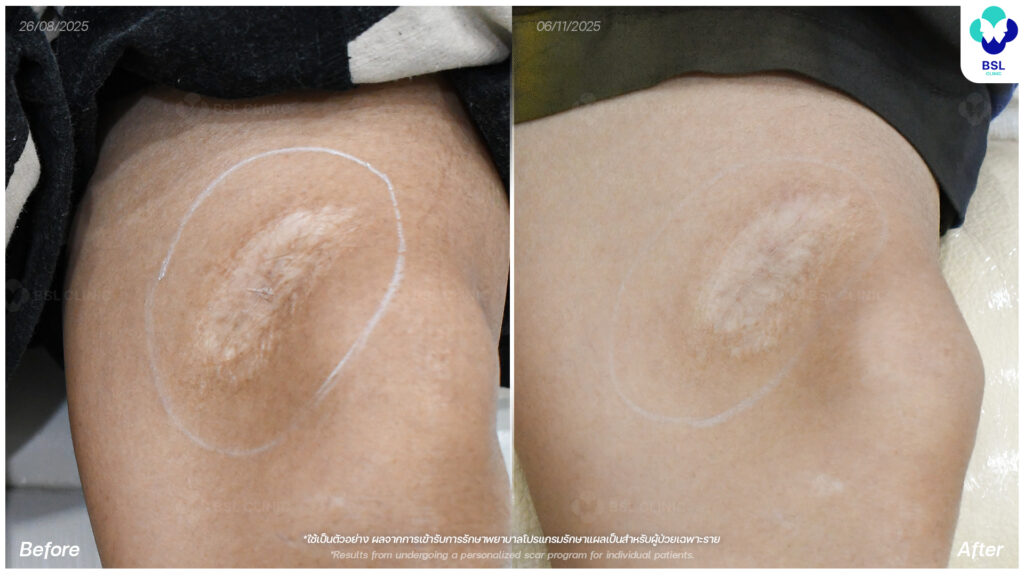 ตัวอย่างผลลัพธ์แผลเป็นเฉพาะบุคคล