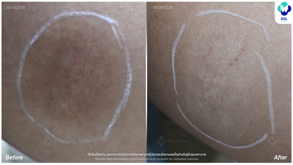 ตัวอย่างผลลัพธ์แผลเป็นเฉพาะบุคคล