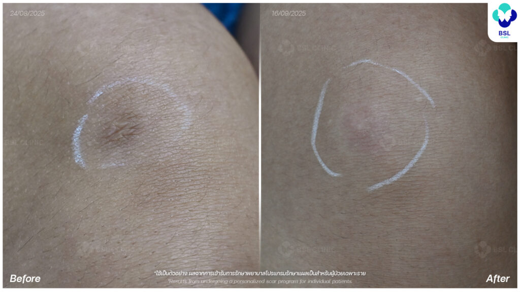 ภาพเปรียบเทียบรอยแผลเป็นก่อน–หลัง