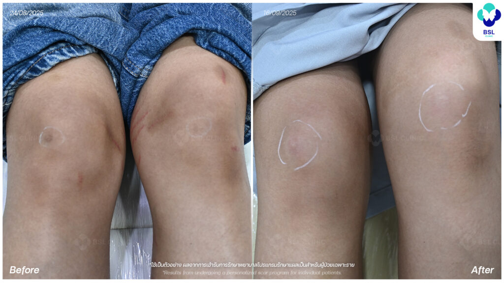 ตัวอย่างผลลัพธ์แผลเป็นเฉพาะบุคคล