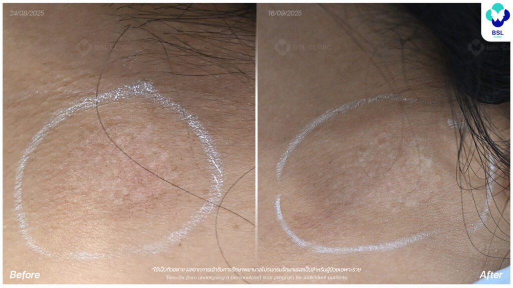 ตัวอย่างผลลัพธ์แผลเป็นเฉพาะบุคคล