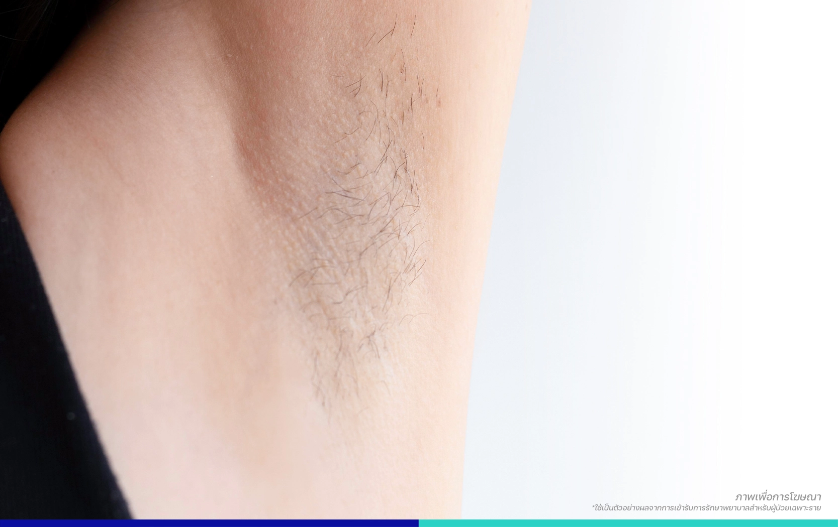 เลเซอร์กำจัดขนรักแร้