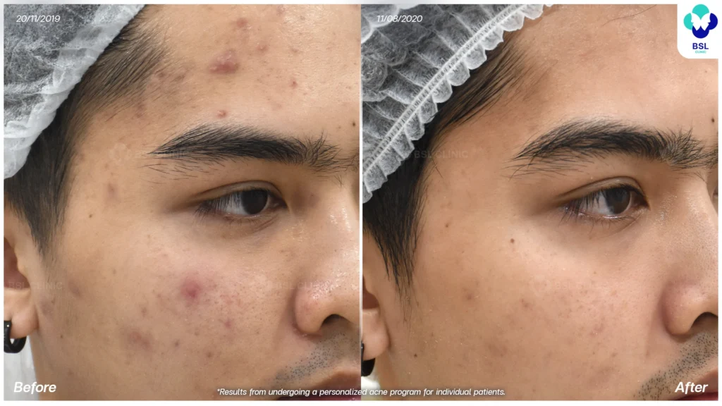 สิวบนใบหน้า