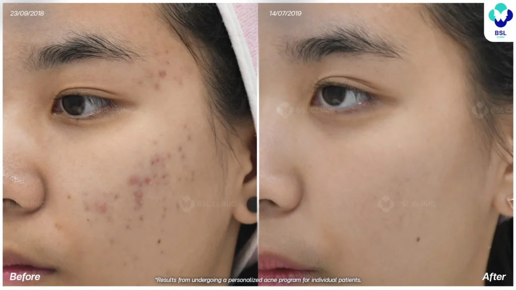 สิวที่แก้ม