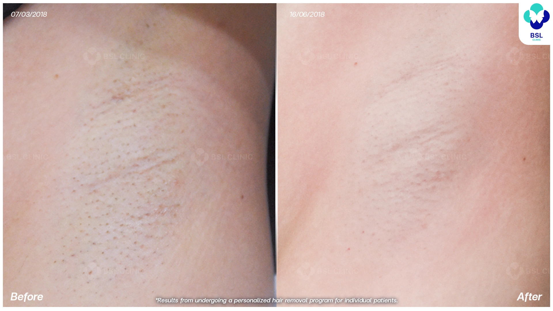 รีวิวเลเซอร์รักแร้