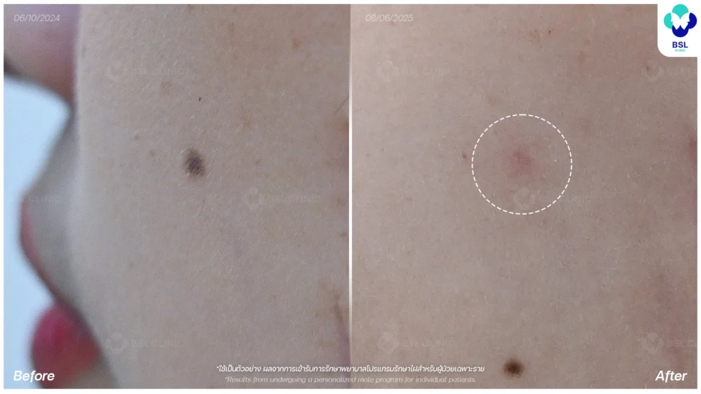 รีวิวรักษาขี้แมลงวัน