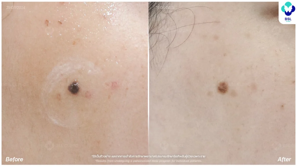 รีวิวรักษาไฝขี้แมลงวัน