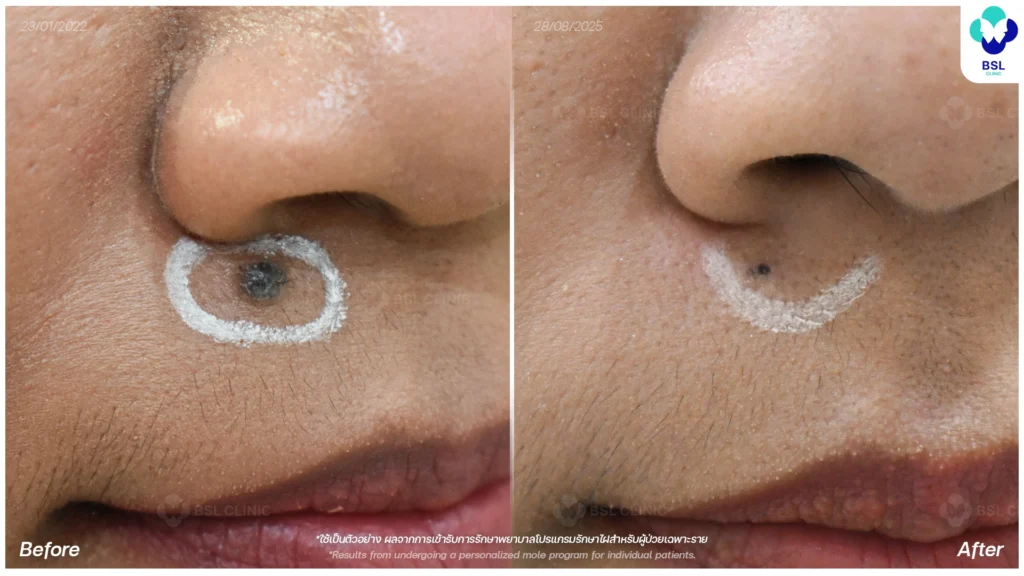 รีวิวรักษาไฝบนใบหน้า