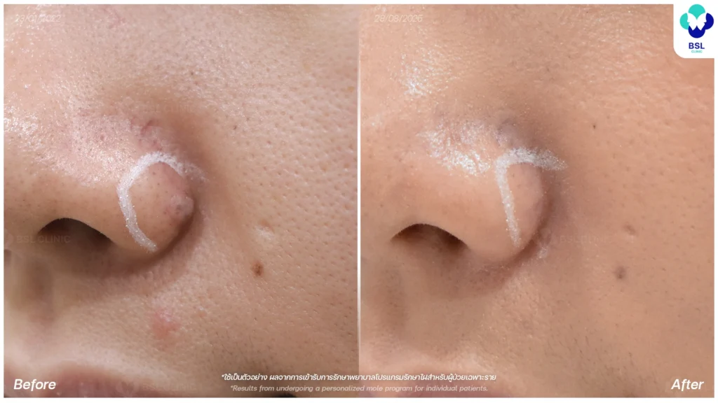 รีวิวเคสไฝและขี้แมลงวันจริง BSL Clinic