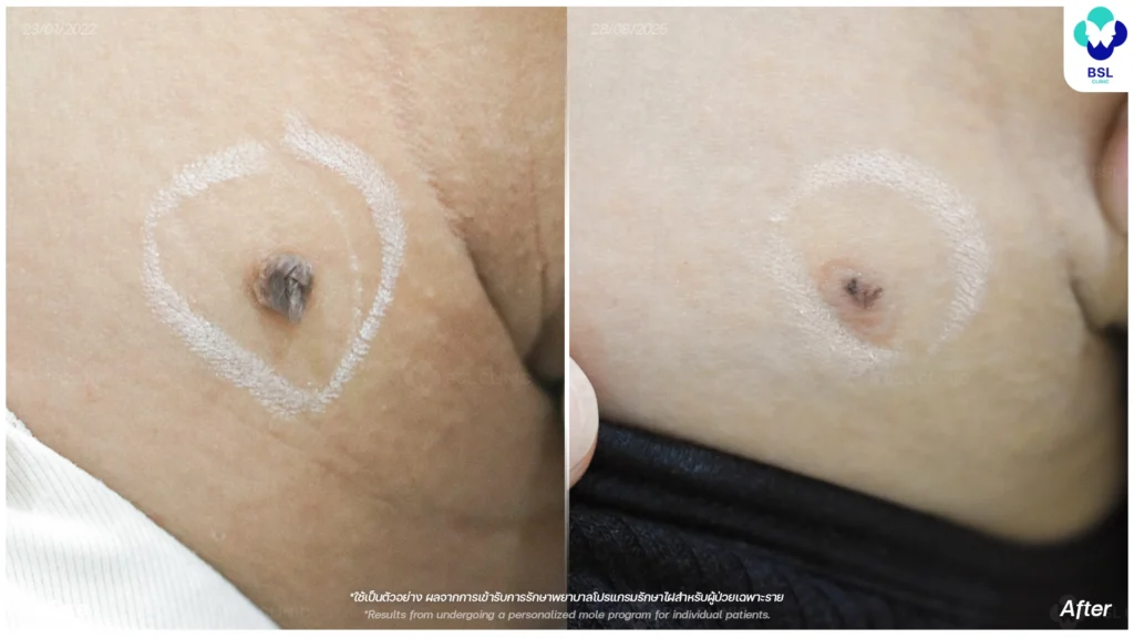 รีวิวเคสไฝและขี้แมลงวันจริง BSL Clinic