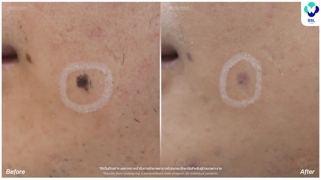 รีวิวรักษาไฝขี้แมลงวัน