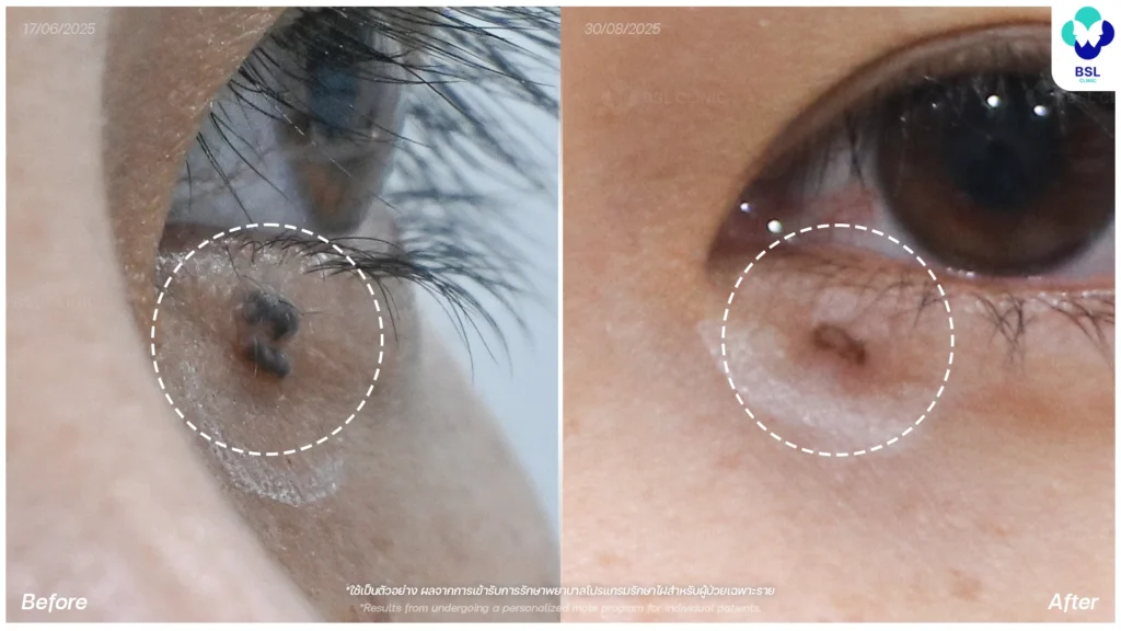 รีวิวรักษาไฝใต้ตา