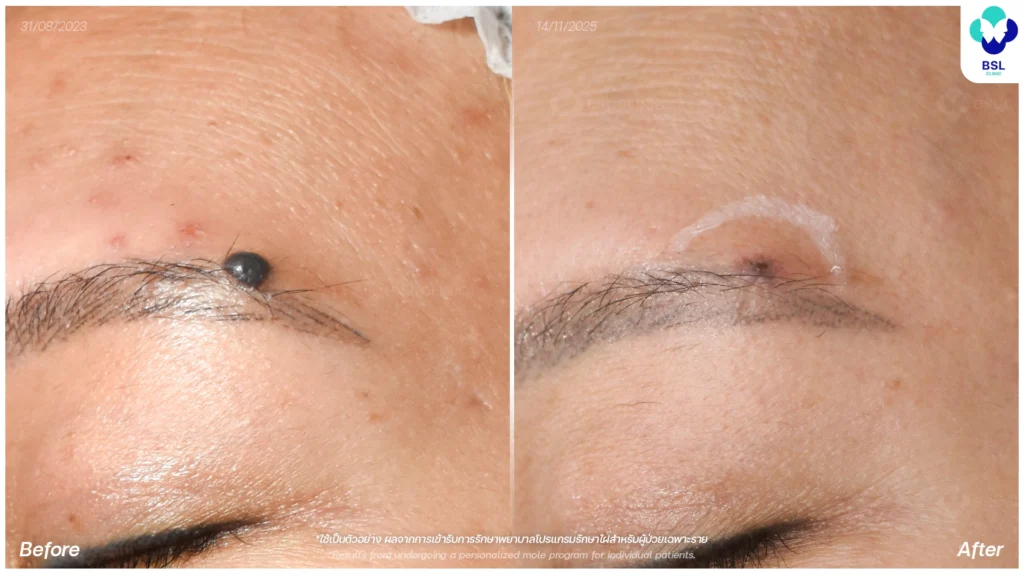 รีวิวรักษาไฝบนใบหน้า