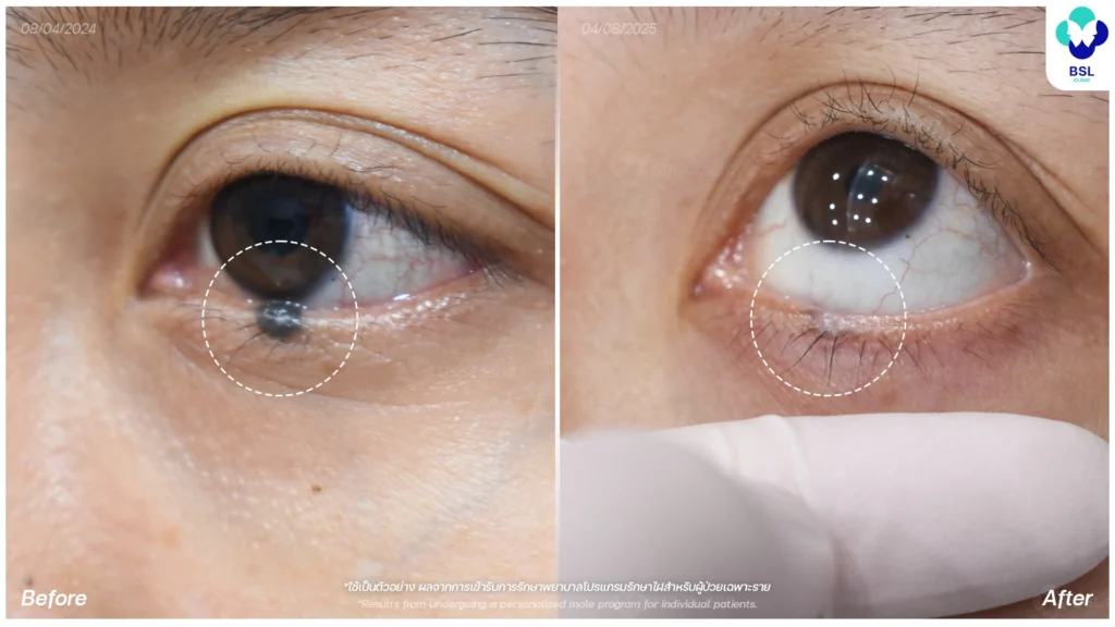 รีวิวรักษาไฝใต้ตา