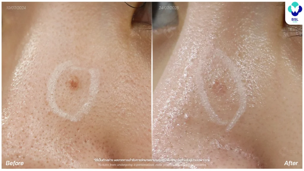 รีวิวรักษาไฝบนใบหน้า