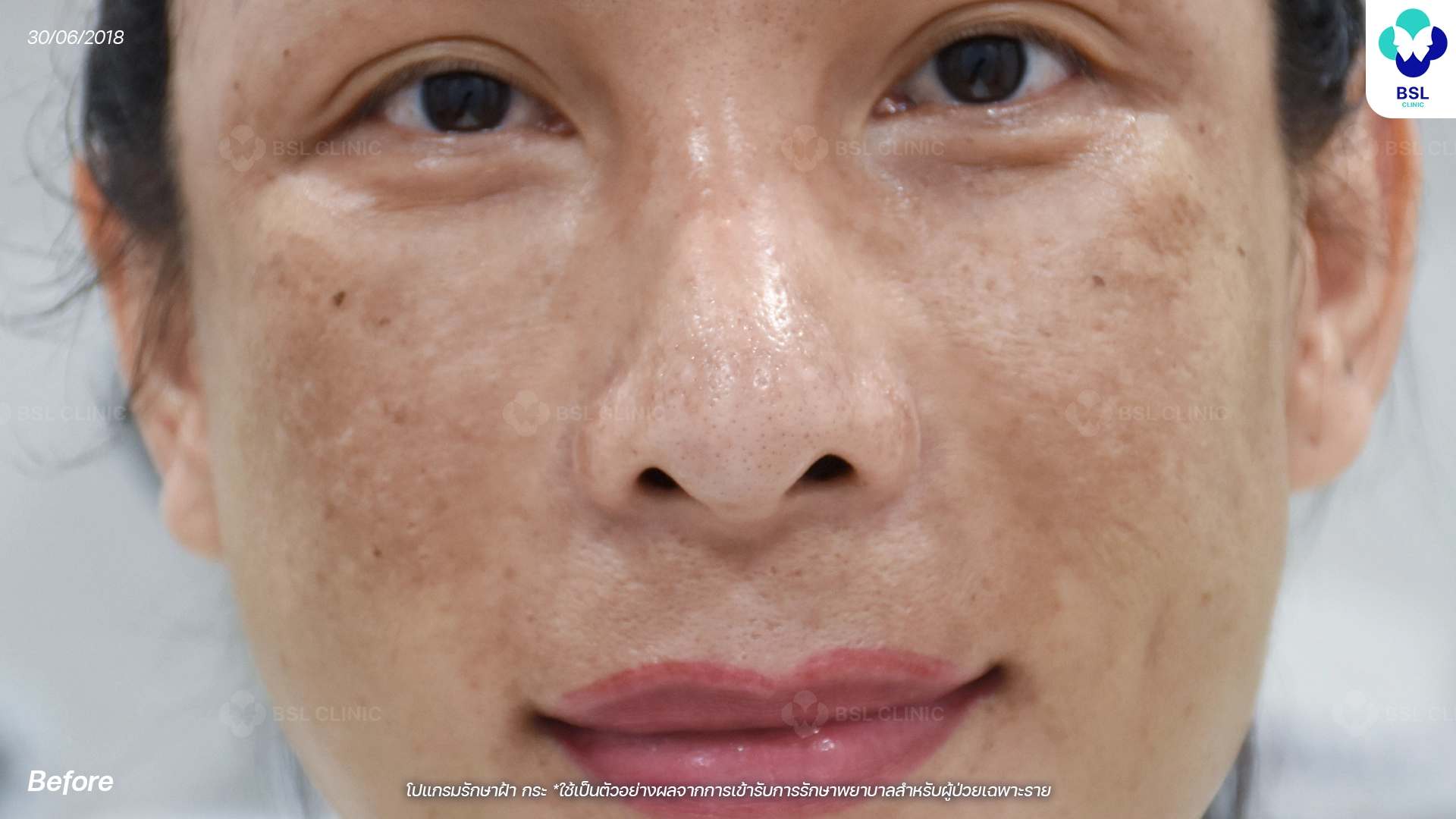 ก่อนรักษาฝ้า