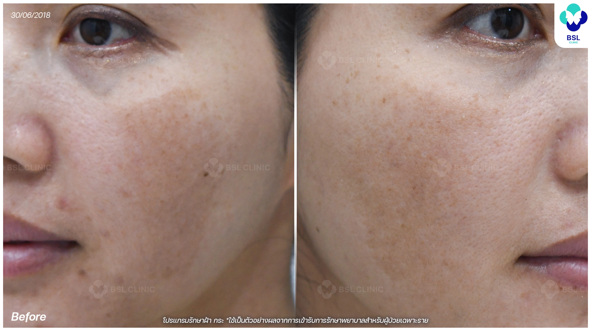 ก่อนรักษาฝ้า