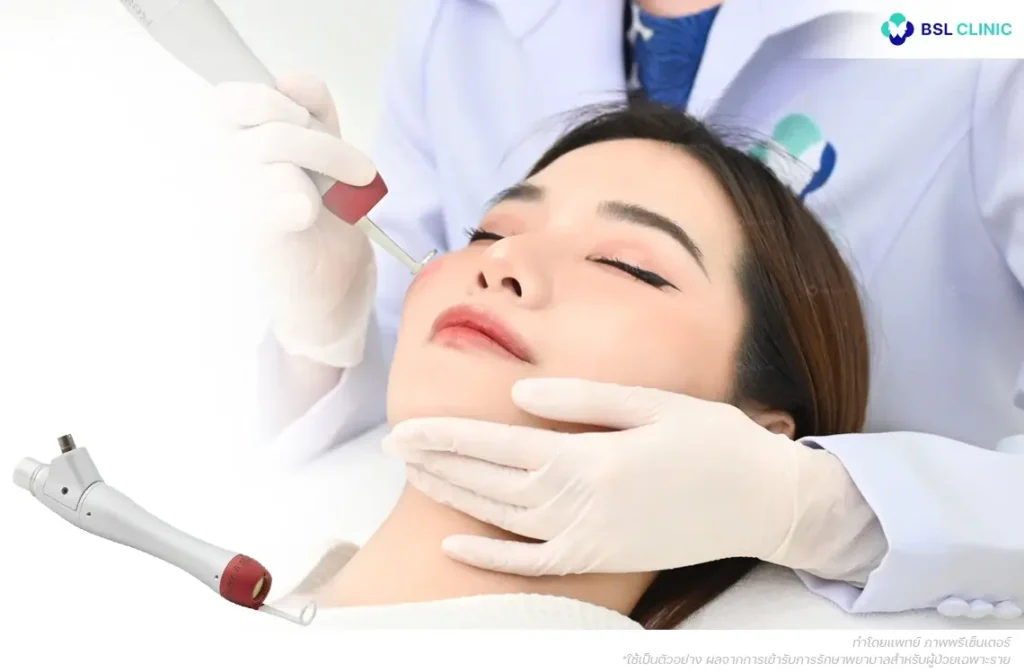 PicoWay Resolve 532nm