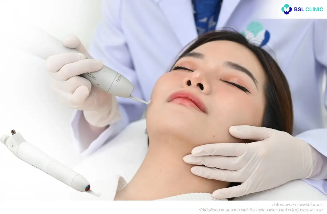 PicoWay 730nm Program