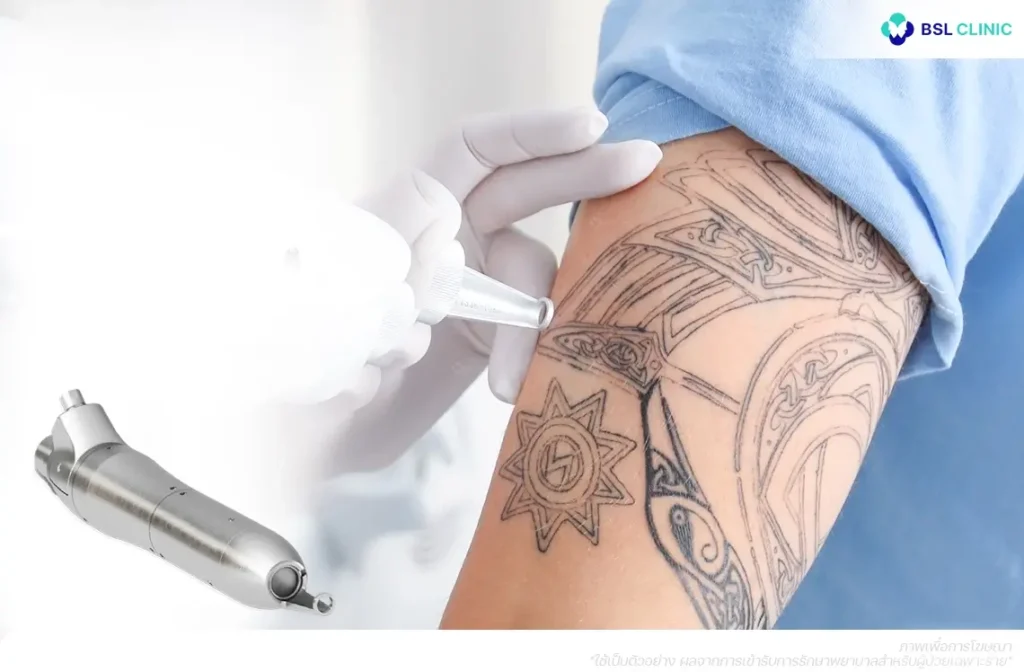 PicoWay 785nm Program