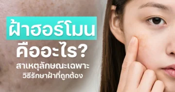 ฝ้าฮอร์โมนเกิดจากอะไร