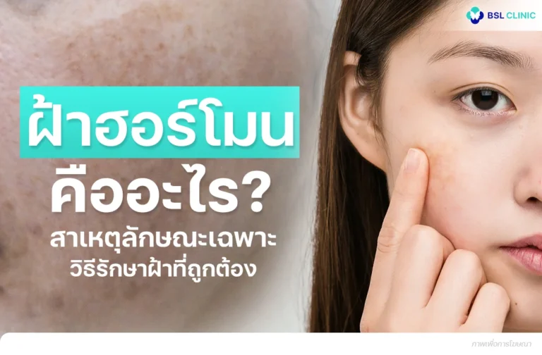 ฝ้าฮอร์โมนเกิดจากอะไร