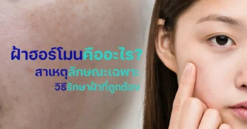 ฝ้าฮอร์โมนเกิดจากอะไร