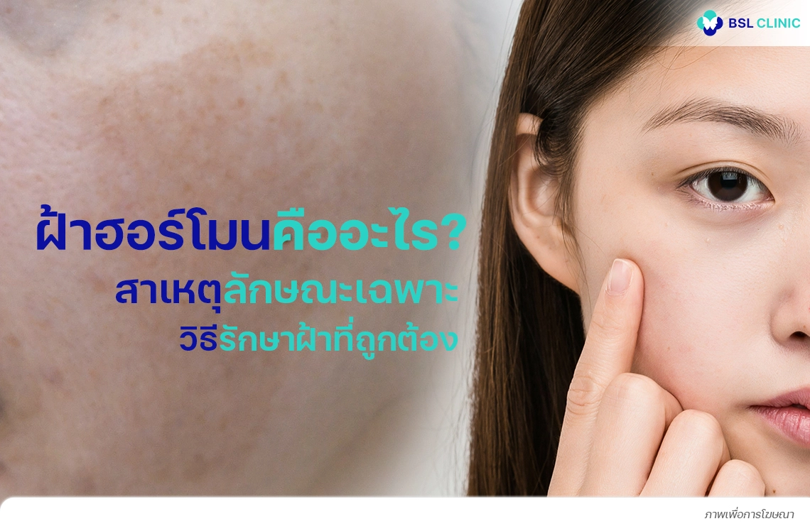 ฝ้าฮอร์โมนเกิดจากอะไร