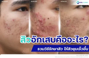 สิวอักเสบคืออะไร