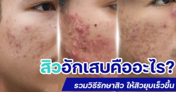 สิวอักเสบคืออะไร