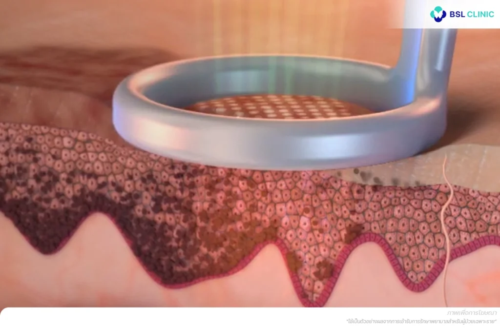 กลไก Photoacoustic ใช้พัลส์สั้นระดับ Picosecond