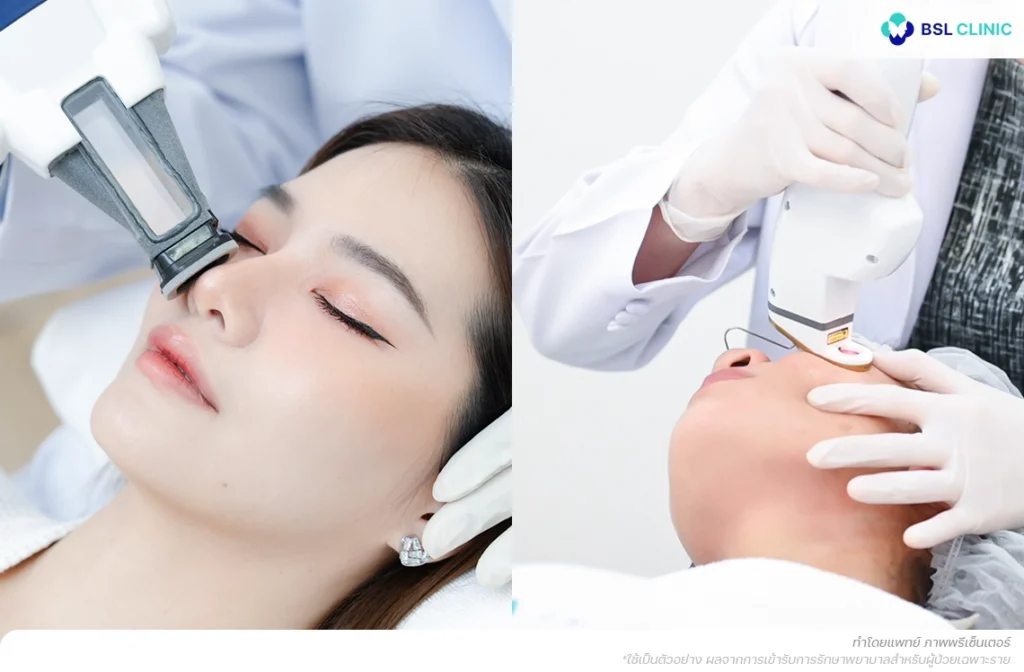 ต่อมไขมันผลิตน้ำมันมากเกินไป