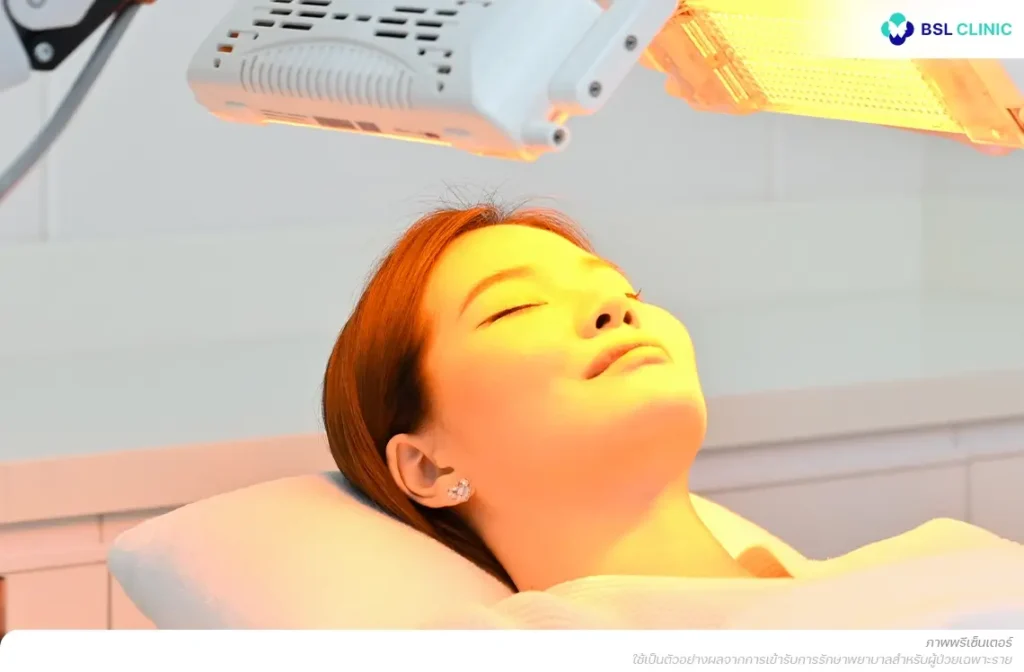 แบคทีเรีย C.acnes