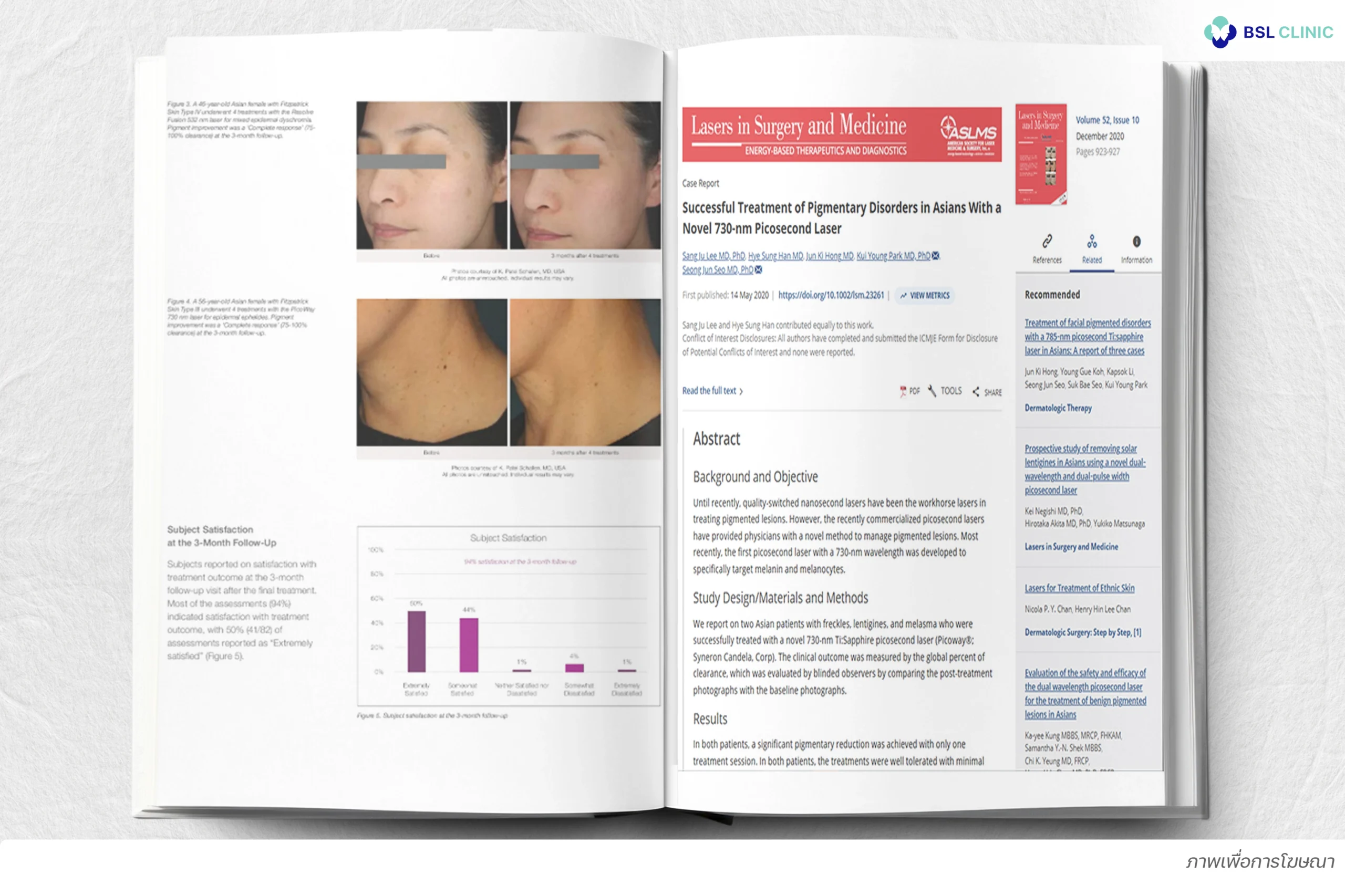 งานวิจัย Program PicoWay 730 nm