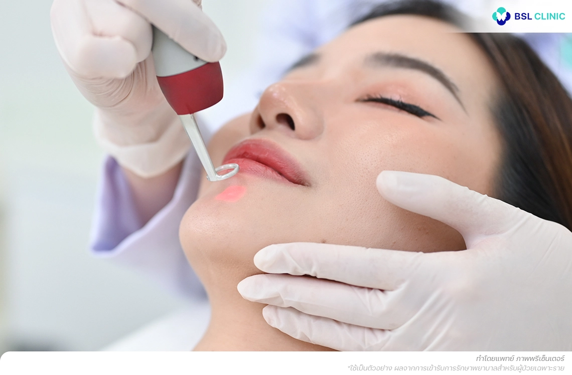 การรักษาด้วยพิโค่เลเซอร์ โปรแกรม