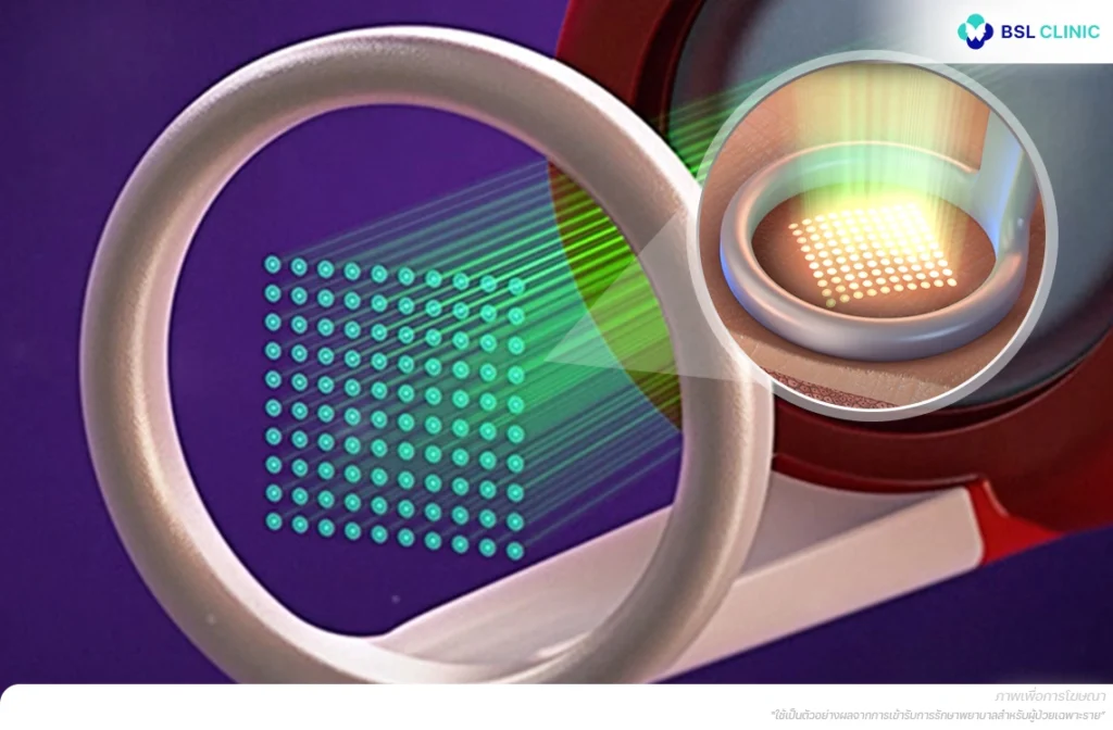 พิโคเลเซอร์พัลส์สั้น 250 ps